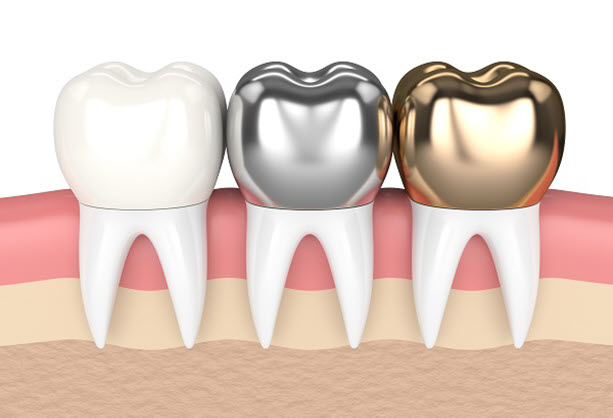 dental-crowns-N2006 - Pascack Dental Arts