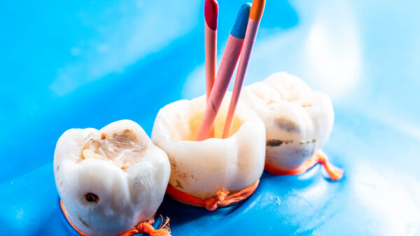 LastStepInRootCanalTreatmentInsertingTheRootCanal - Pascack Dental Arts Close-up of three white tooth models with colored candles inserted into them, tied with orange strings on a bright blue background