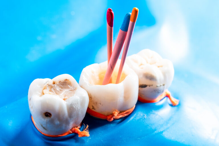 LastStepInRootCanalTreatmentInsertingTheRootCanal - Pascack Dental Arts Close-up of three white tooth models with colored candles inserted into them, tied with orange strings on a bright blue background