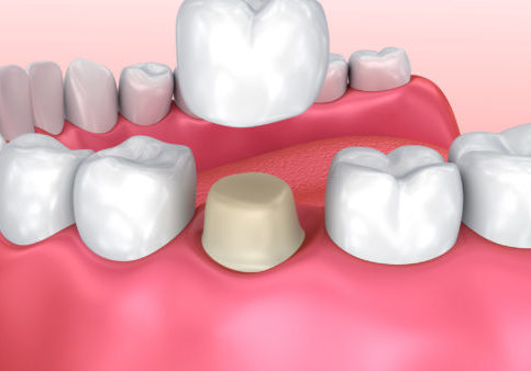 How Long Should Crowns Last And When Should They Be Changed 1