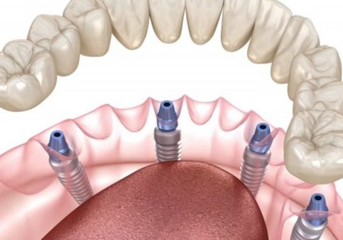 Implants-Pascack-Dental 1