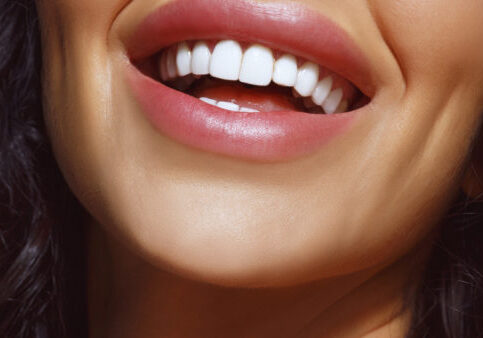 Tooth Whitening