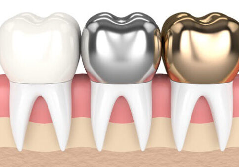 dental-crowns-N2006