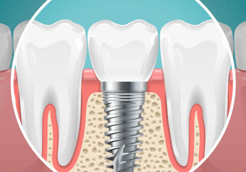 dental-implants-in-flat-rock-nc_1KAX3UV