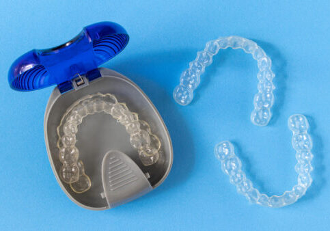 Invisalign,Braces,Or,Invisible,Retainer,On,Blue,Background