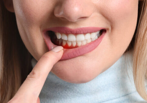 Woman,With,Gum,Inflammation,,Closeup