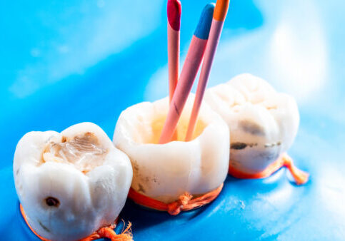 Close-up of three white tooth models with colored candles inserted into them, tied with orange strings on a bright blue background