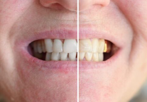 Before,And,After,Teeth,Whitening,Procedure.