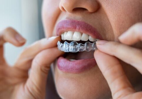 Close-up,Of,Woman,Wearing,Orthodontic,Silicone,Trainer.,Invisible,Braces,Aligner.