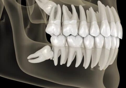 Mesial impaction of Wisdom teeth to the second molar. Medically accurate tooth 3d animation